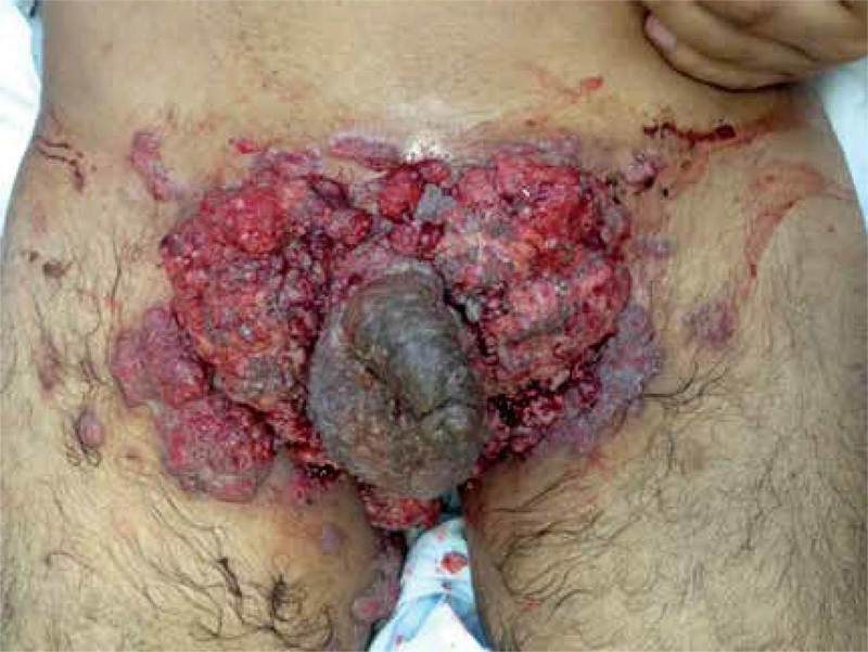 Tumor In Penis 21
